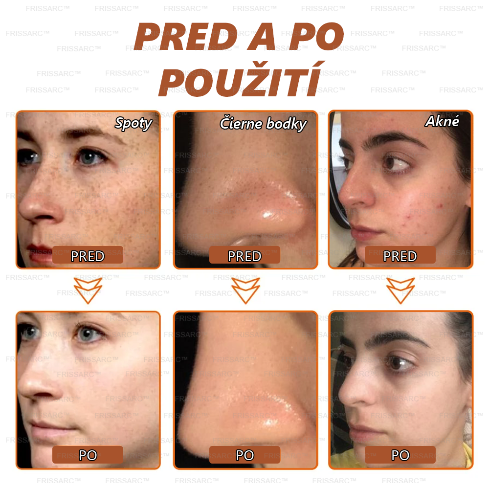 💧FRISSARC™ bieliaca a škvrny odstraňujúca pleťová maska – Prírodné zložky trvalo odstraňujú pigmentové škvrny, starecké škvrny, pehy a slnečné škvrny.