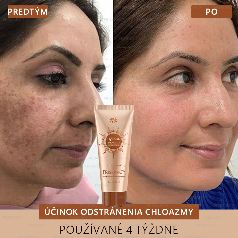 💧FRISSARC™ bieliaca a škvrny odstraňujúca pleťová maska – Prírodné zložky trvalo odstraňujú pigmentové škvrny, starecké škvrny, pehy a slnečné škvrny.
