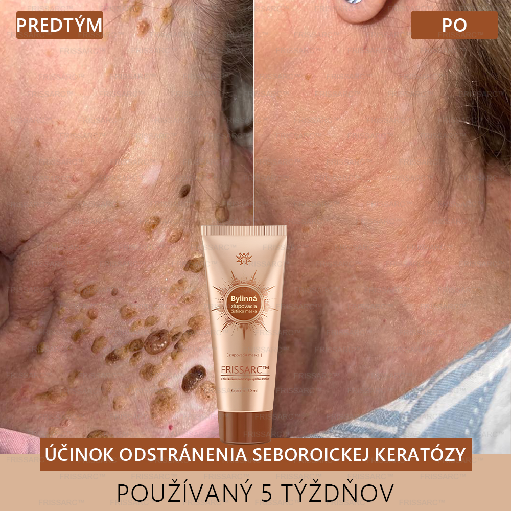 💧FRISSARC™ bieliaca a škvrny odstraňujúca pleťová maska – Prírodné zložky trvalo odstraňujú pigmentové škvrny, starecké škvrny, pehy a slnečné škvrny.