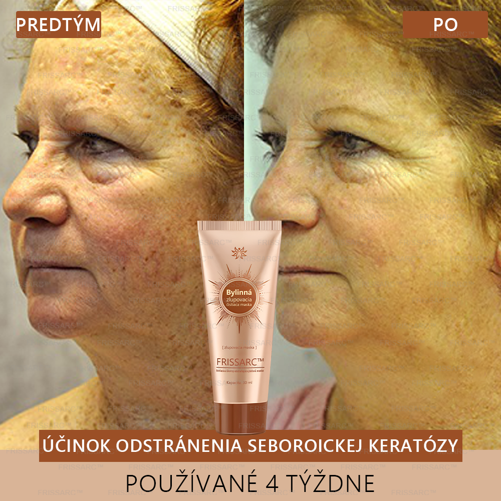 💧FRISSARC™ bieliaca a škvrny odstraňujúca pleťová maska – Prírodné zložky trvalo odstraňujú pigmentové škvrny, starecké škvrny, pehy a slnečné škvrny.
