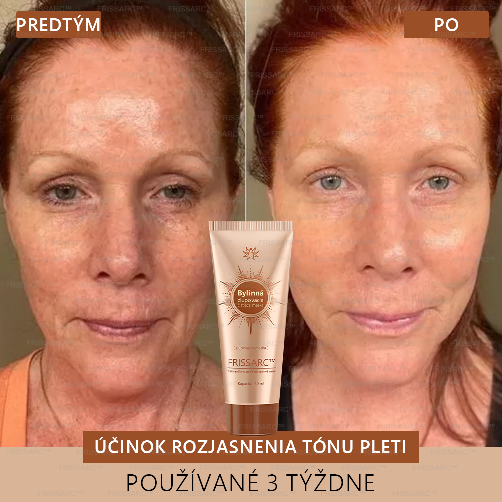 💧FRISSARC™ bieliaca a škvrny odstraňujúca pleťová maska – Prírodné zložky trvalo odstraňujú pigmentové škvrny, starecké škvrny, pehy a slnečné škvrny.