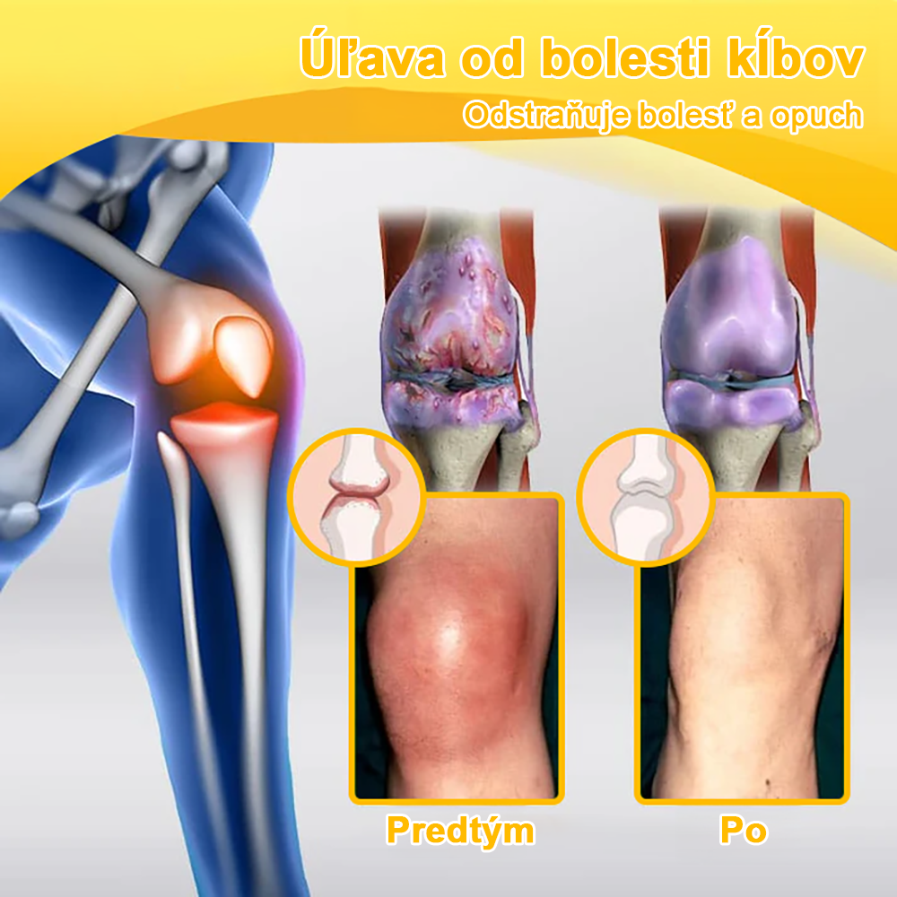 🏆【Oficiálny značkový obchod】𝐀𝐫𝐭𝐫𝐨𝐅𝐥𝐞𝐱𝐢𝐬™ 𝐊𝐫é𝐦 𝐧𝐚 𝐫𝐞𝐠𝐞𝐧𝐞𝐫á𝐜𝐢𝐮 𝐤ĺ𝐛𝐨𝐯 𝐬 𝐯č𝐞𝐥í𝐦 𝐣𝐞𝐝𝐨𝐦(Extrakt z novozélandského včelieho jedu - špecializovaný na ortopedické ochorenia - Certifikovaný CE)